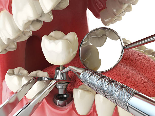 Best Emergency Treatment for Dental Infections or Abscesses in Lincolnshire, IL